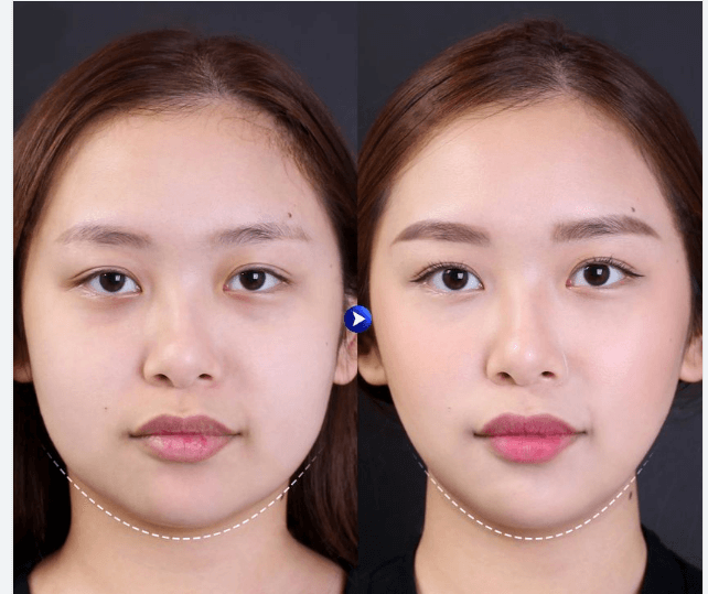 Xeomin vline giữ được bao lâu