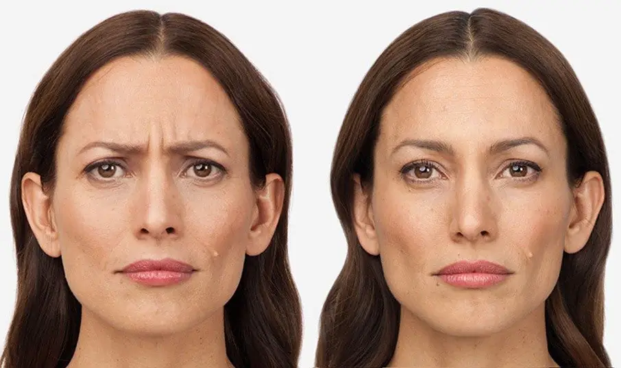 Thành phần và cơ chế hoạt động — botox so sánh xeomin