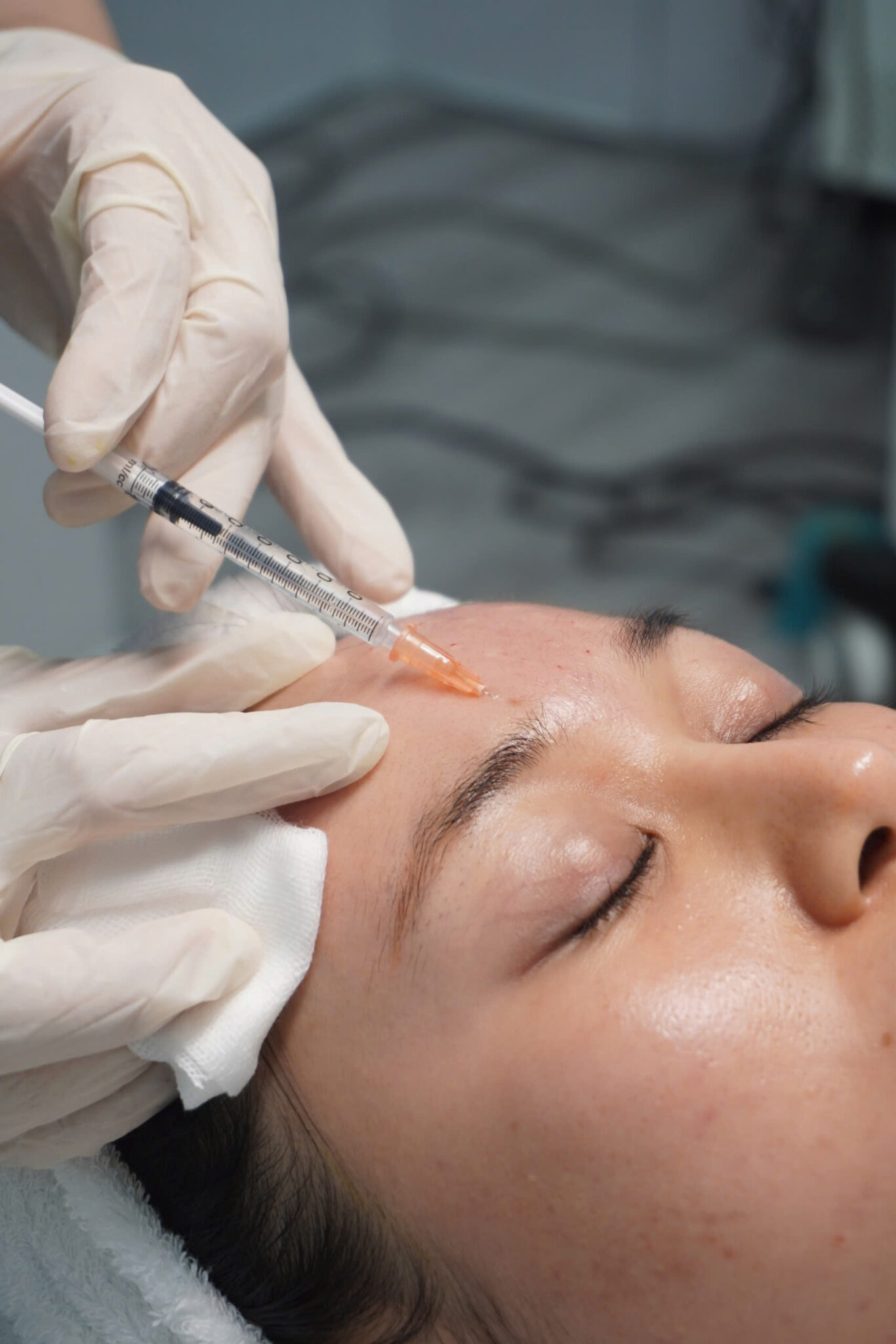 nếp nhăn cau mày, botox cau mày giá bao nhiêu, xóa nhăn giữa chân mày, nguyên nhân cau mày có nếp nhăn, ,