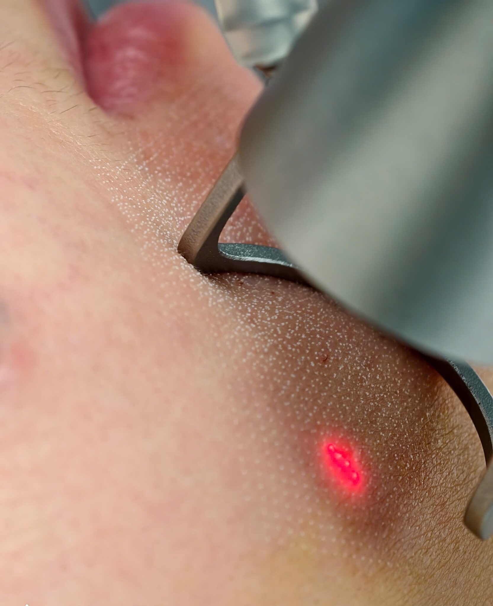 ISOV sau laser, ISOV sau laser, sản phẩm ISOV sau laser, kem tái tạo da ISOV, chăm sóc da sau laser, phục hồi da sau laser