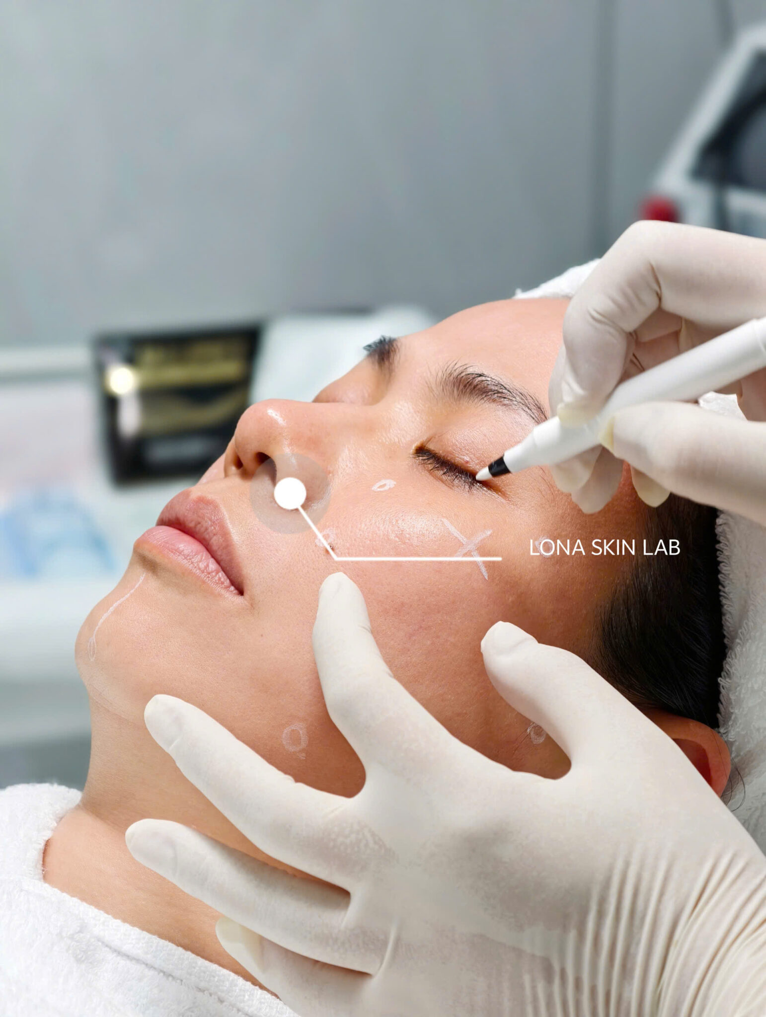 điều trị thâm mắt không hiệu quả, điều trị thâm mắt, thâm mắt không hiệu quả, phân loại thâm mắt, sai lầm điều trị thâm mắt, Lona Skin Lab