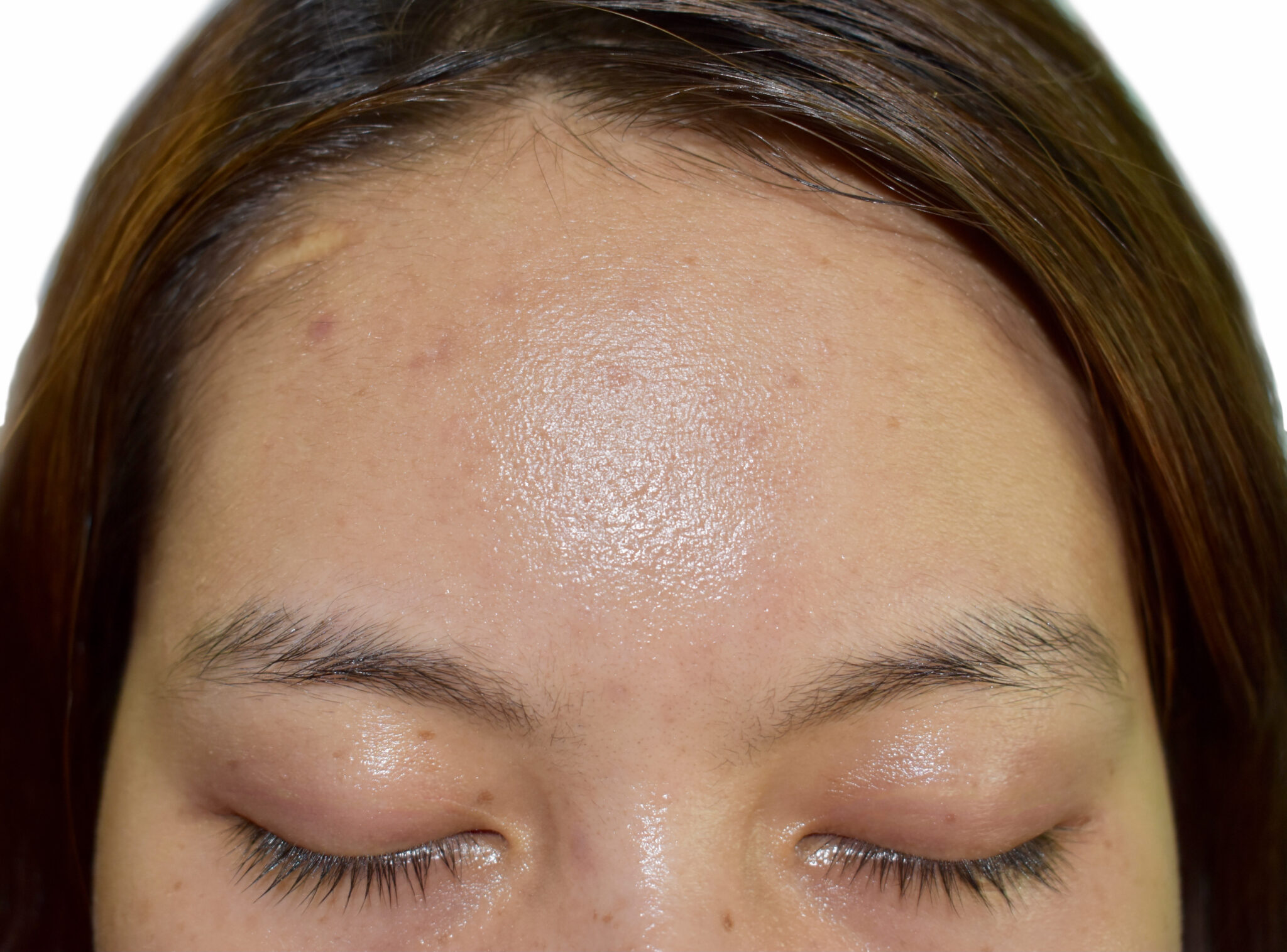 Hình ảnh minh họa cho liệu pháp loại da - bước da dầu, nội dung ảnh: dadau9.