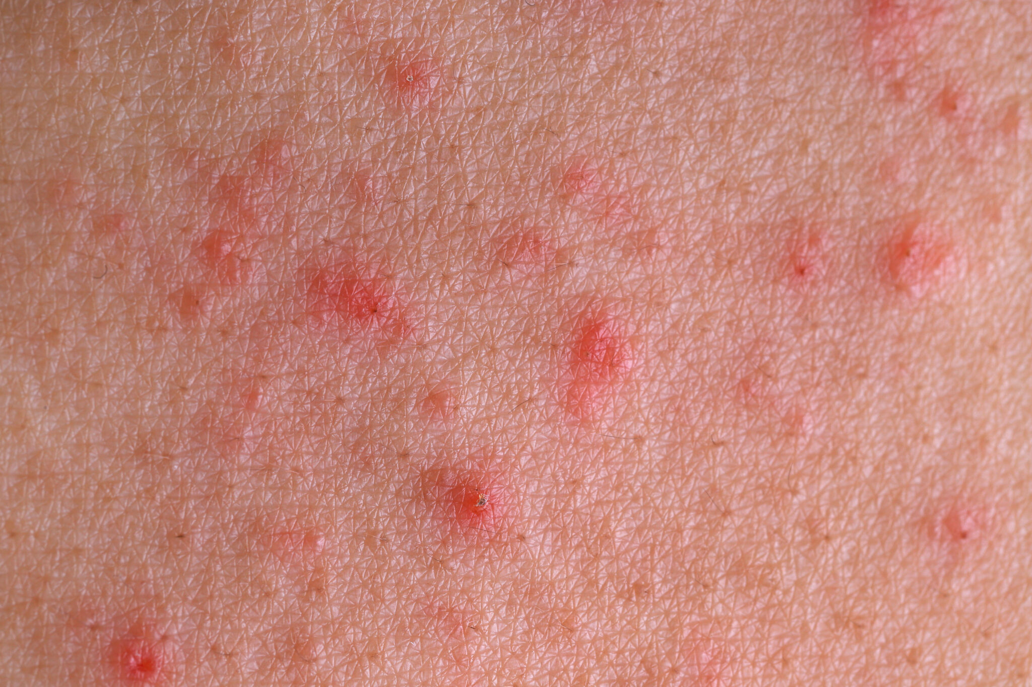 Hình ảnh minh họa cho liệu pháp loại da - bước da yếu, nội dung ảnh: dayeu9.