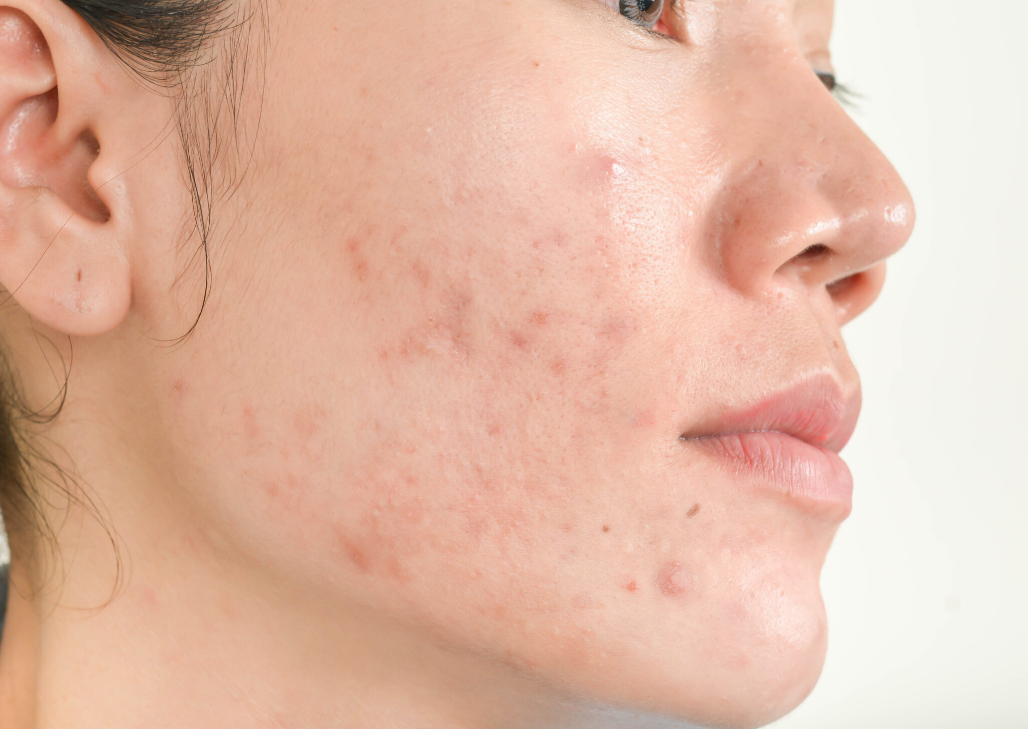 Phenoxyethanol tác dụng phụ