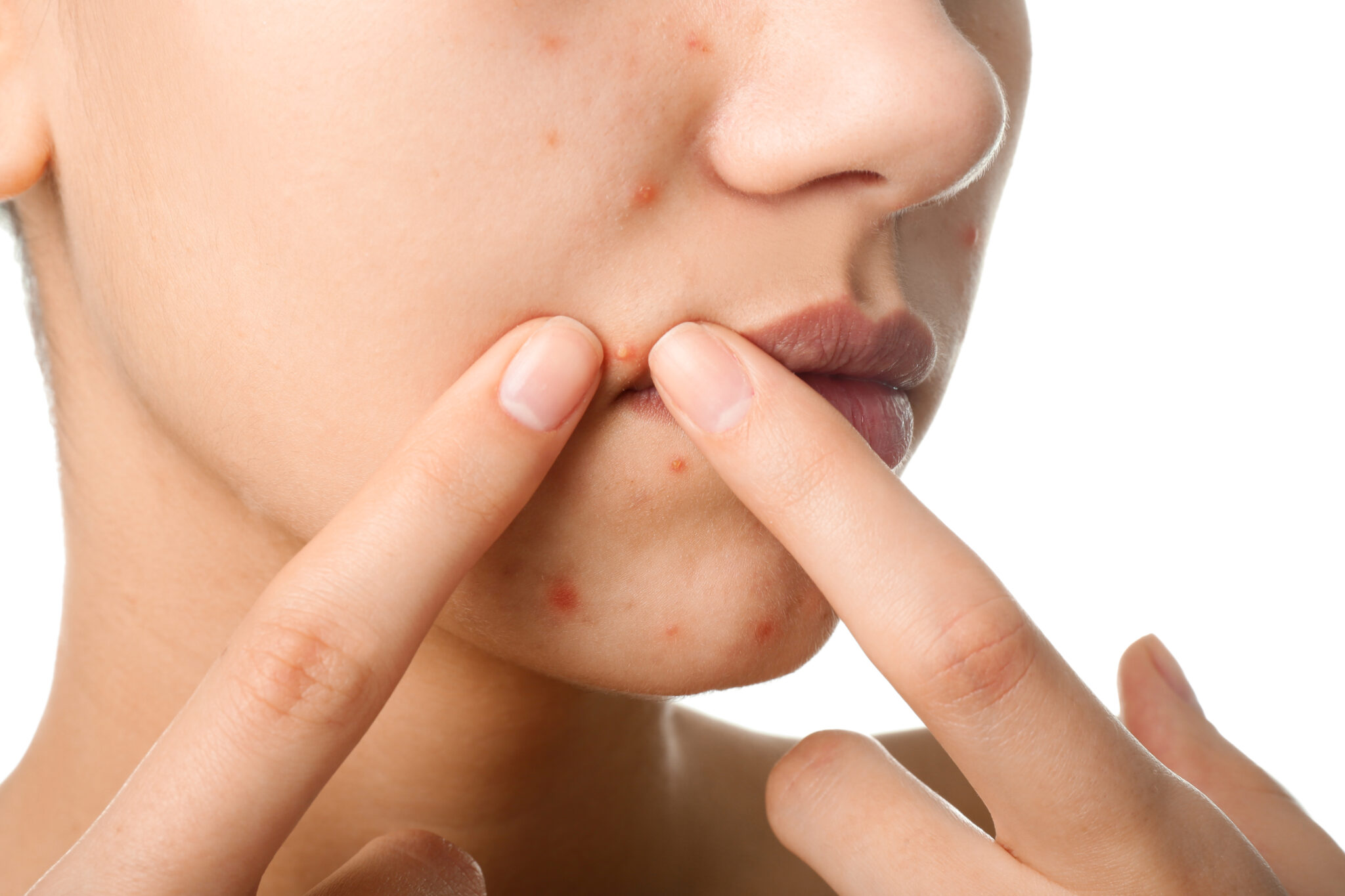 Vivant Derm-A-Gel, Vivant Derm-A-Gel, sản phẩm trị mụn, tái tạo da, công dụng Vivant Derm-A-Gel,