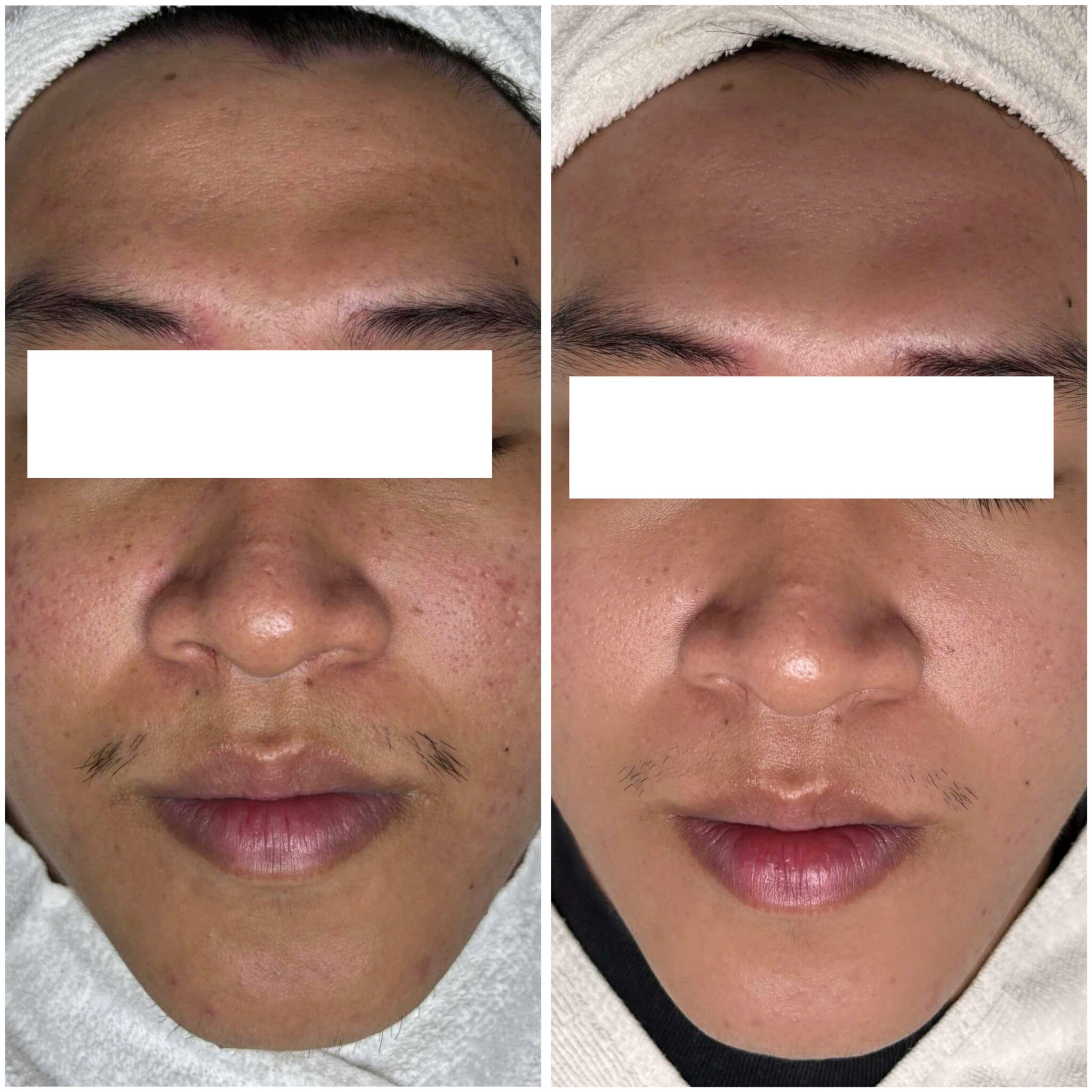 Khi áp dụng liệu pháp, Tác dụng của tiêm BAP Karisma được kết hợp cùng những phát hiện về công dụng của tiêm Karisma với sẹo rỗ, tạo điều kiện tối ưu cho quá trình sửa chữa da và tái tạo cấu trúc ECM bền vững.