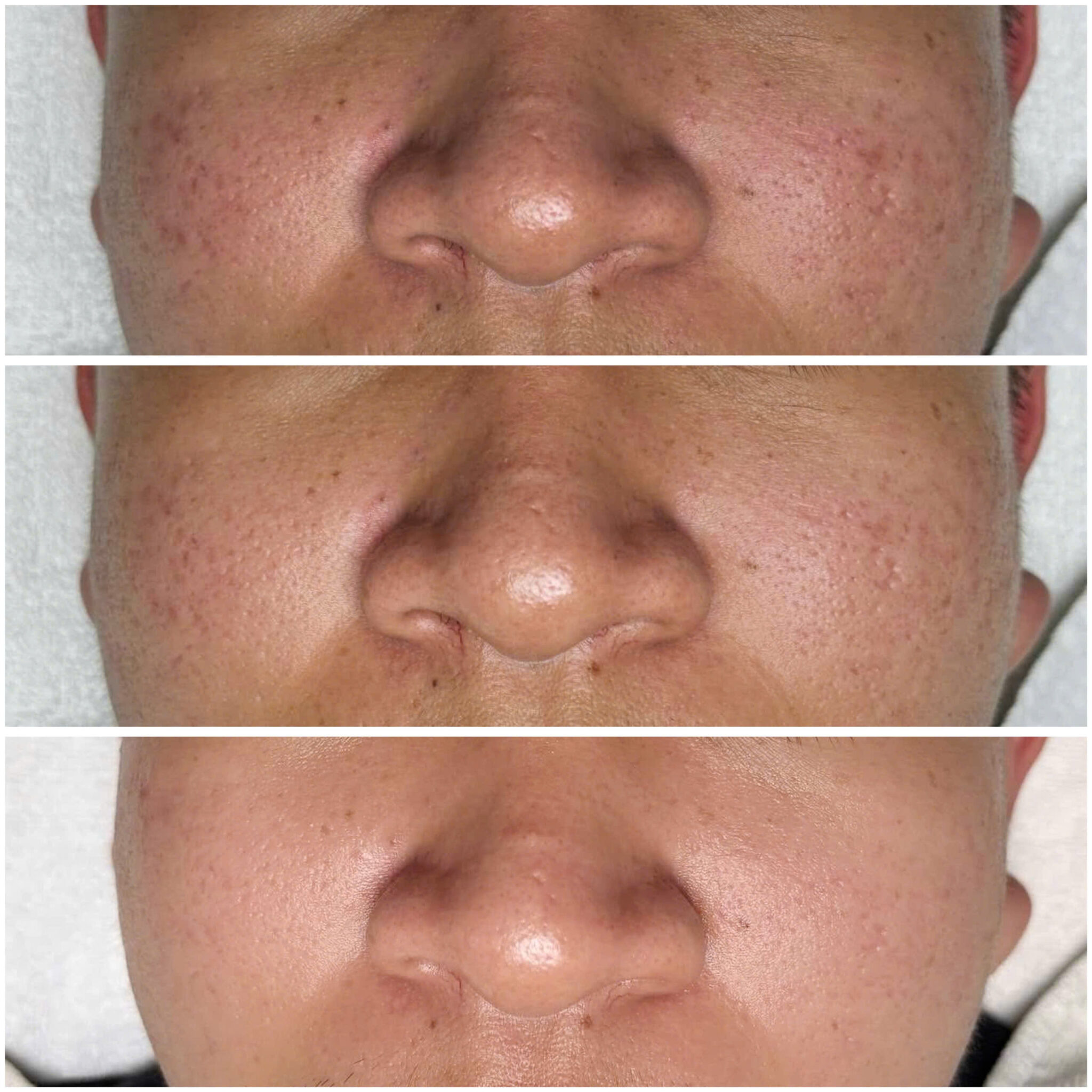 Hình ảnh minh họa cho liệu pháp vấn đề da - bước sẹo rỗ, nội dung ảnh: seoro4.