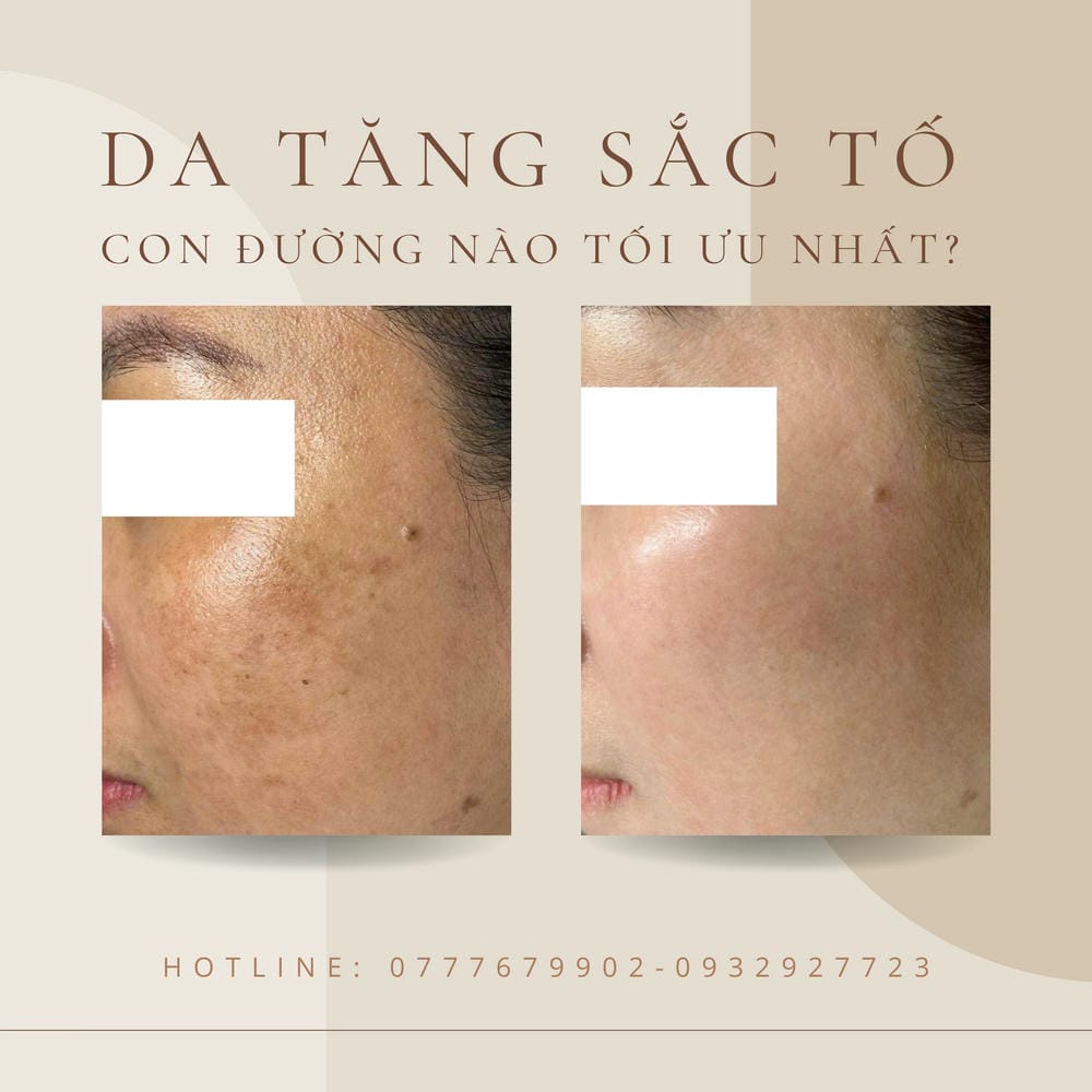 Bằng chứng và thời gian mong đợi cho PIH sau mụn