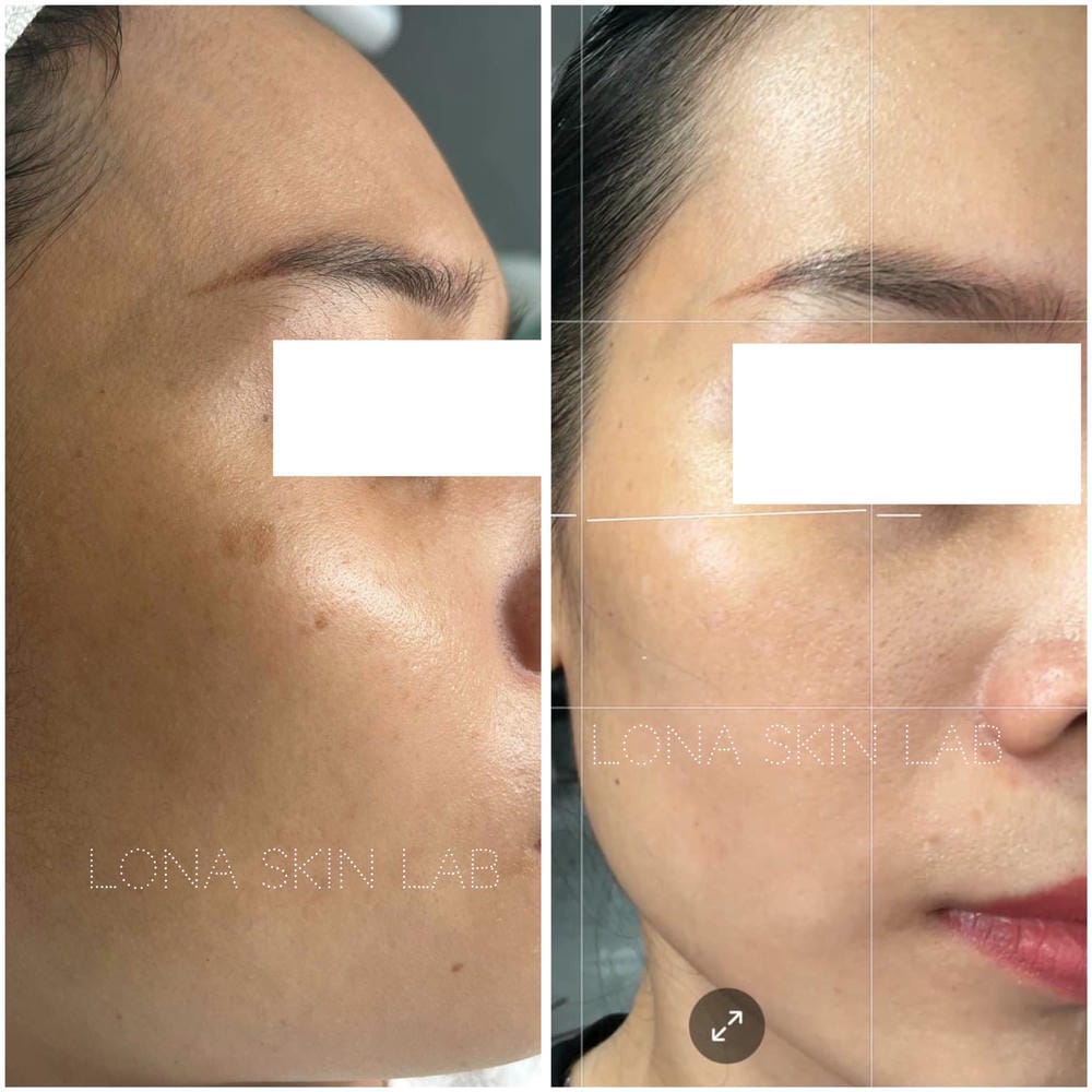 Ai phù hợp dùng Azelaic acid, ai nên chọn BHA hoặc kết hợp — hướng dẫn thực tế