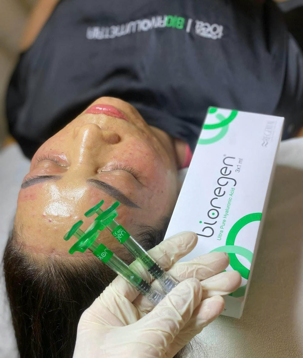 Quy trình điều trị Bioregen Meso thường diễn ra như thế nào và cần bao nhiêu buổi?