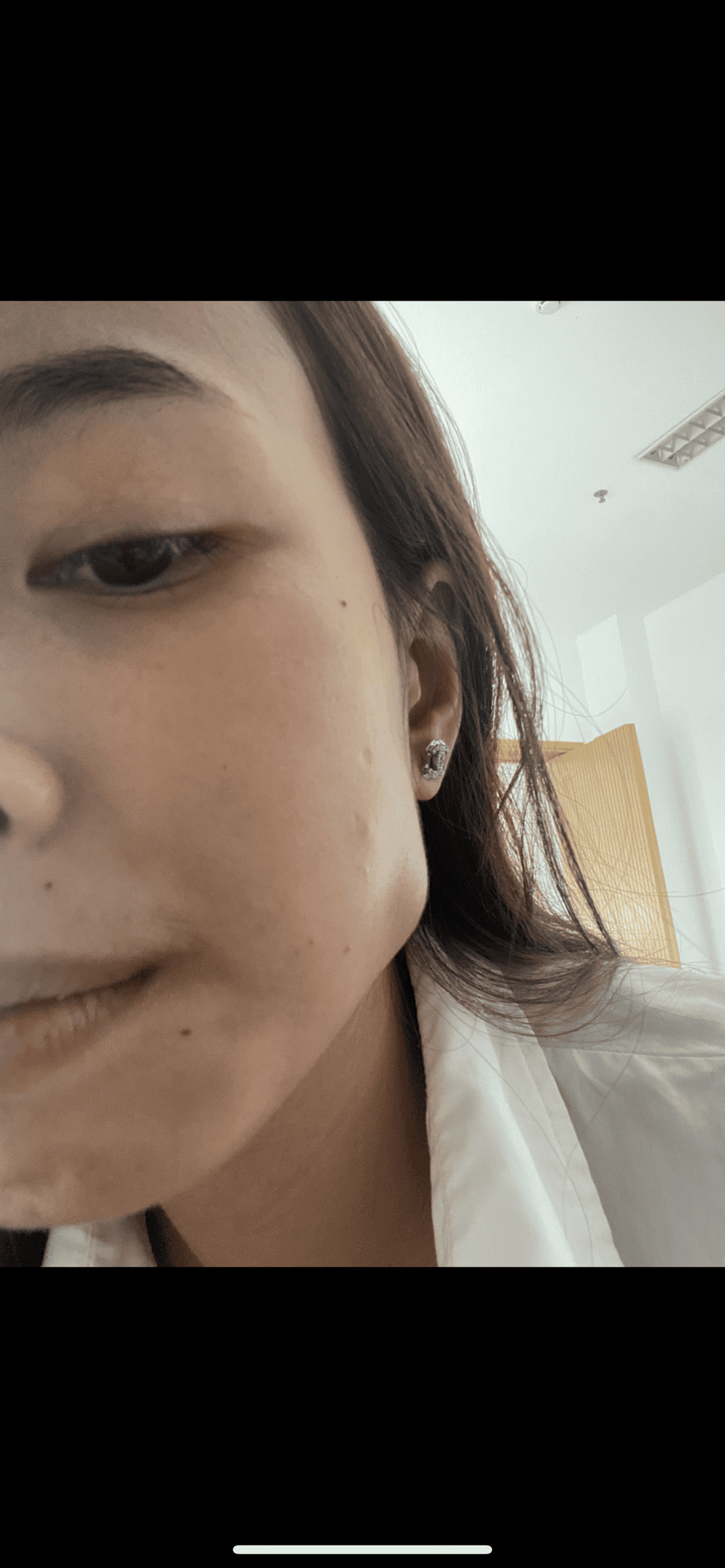 Dấu hiệu biến chứng tiêm botox cần can thiệp y tế ngay?