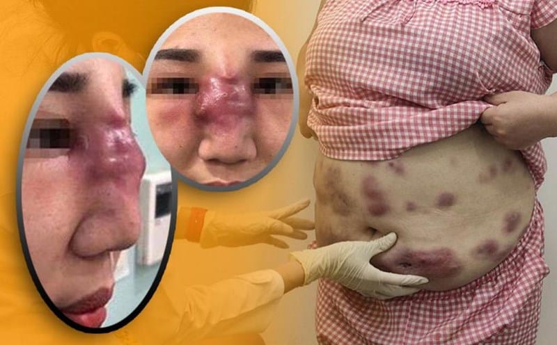 Câu hỏi thường gặp về da lồi lõm sau tiêm Botox