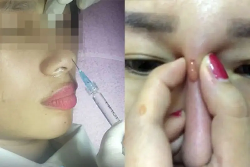 Các loại filler cho mũi — loại nào nên cân nhắc và những nhãn hàng đang có mặt tại Việt Nam?