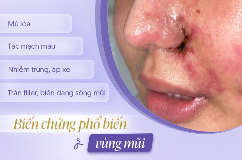 Những ai không phù hợp hoặc cần thận trọng khi tiêm filler mũi?