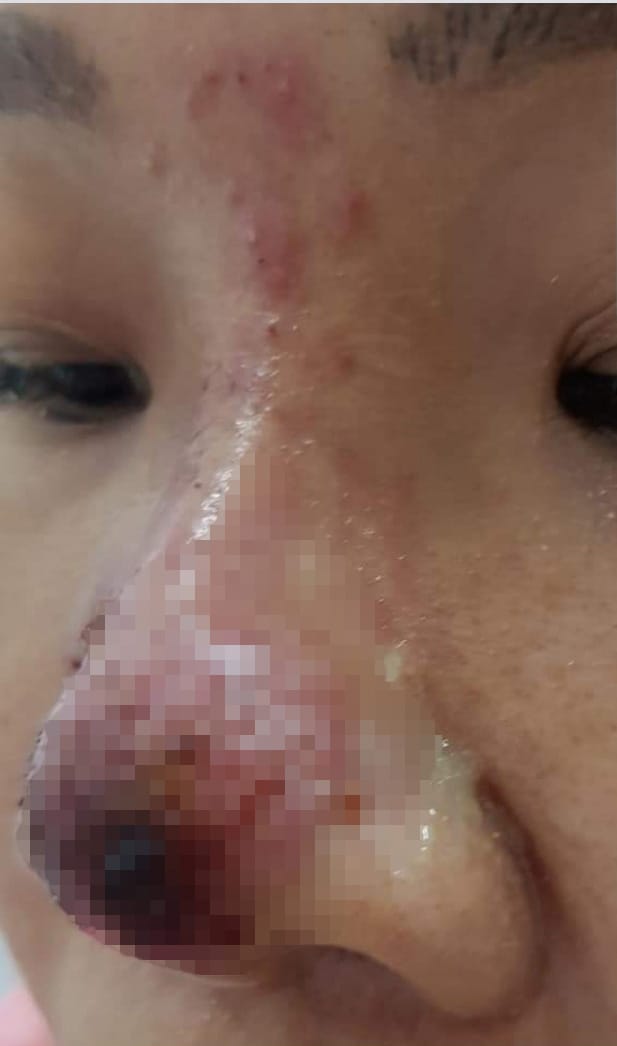 Bằng chứng lâm sàng và hướng dẫn chuyên môn gần đây nói gì về xử trí biến chứng filler?