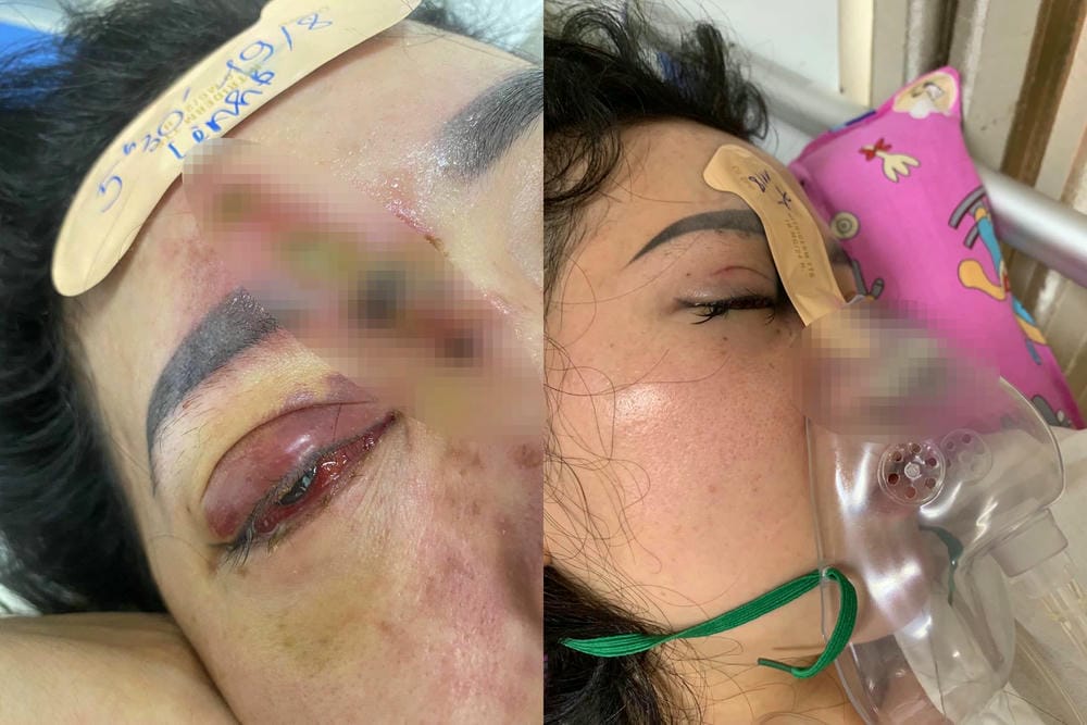 Nếu gặp tắc mạch filler hoặc thay đổi thị lực, bước xử trí cấp cứu là gì?