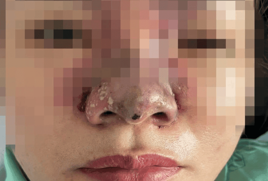 So sánh rủi ro giữa các loại filler và vai trò hyaluronidase
