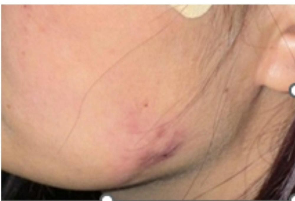 Làm thế nào để phòng ngừa biến chứng khi muốn tiêm Botox?