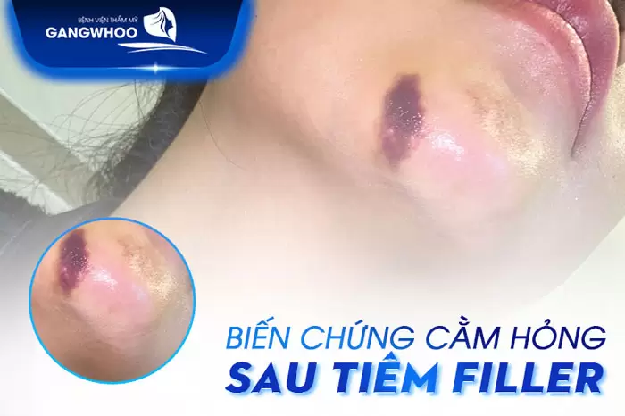 Lựa chọn filler nào an toàn cho cằm — và những dòng được khuyến nghị tại Việt Nam?