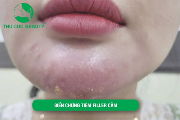 Chăm sóc sau tiêm filler cằm — những lưu ý để giảm biến chứng