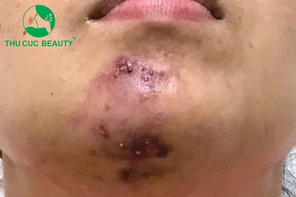 Ở trường hợp đã gặp biến chứng nặng — liệu có thể sửa được hoàn toàn?