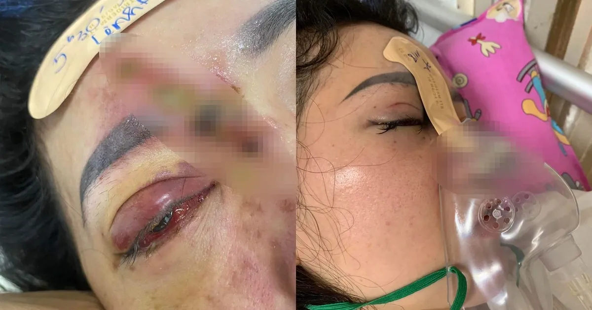 Nếu bị tắc mạch hoặc giảm thị lực ngay sau tiêm, cần xử trí thế nào?