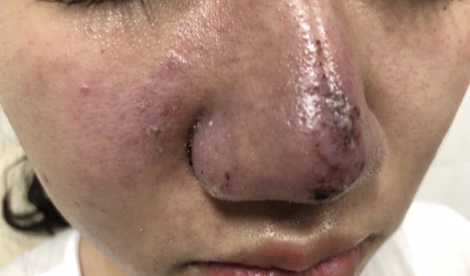 Ngoài tắc mạch và mù, còn những biến chứng nào khác sau tiêm filler mũi — và cách xử trí ra sao?