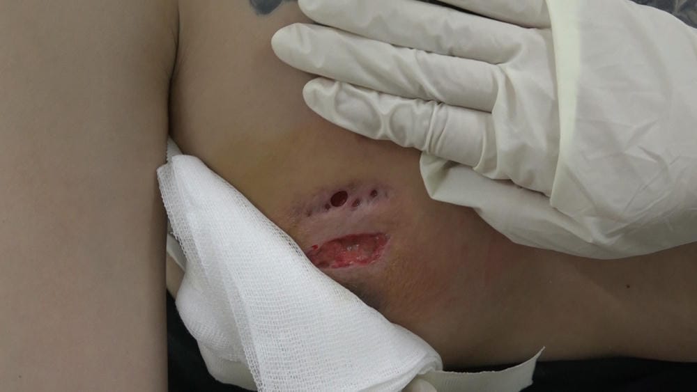 Tiêm filler vào ngực thường dùng những chất gì — và chúng khác nhau ra sao?
