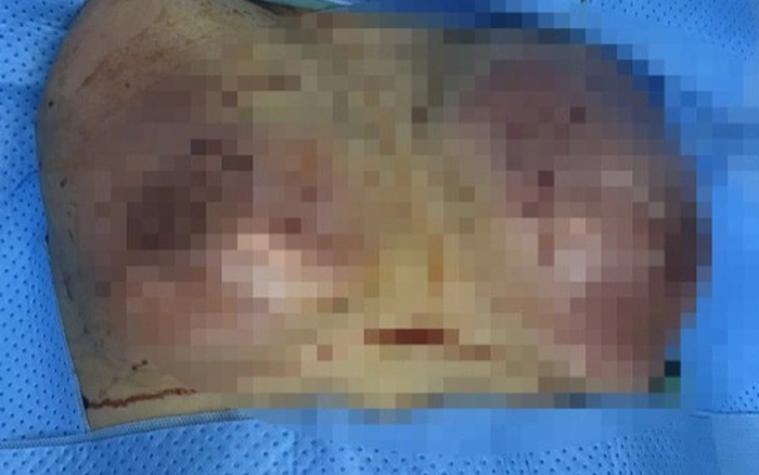 Chẩn đoán hình ảnh và nguy cơ can thiệp tầm soát ung thư vú — filler có làm khó bác sĩ không?
