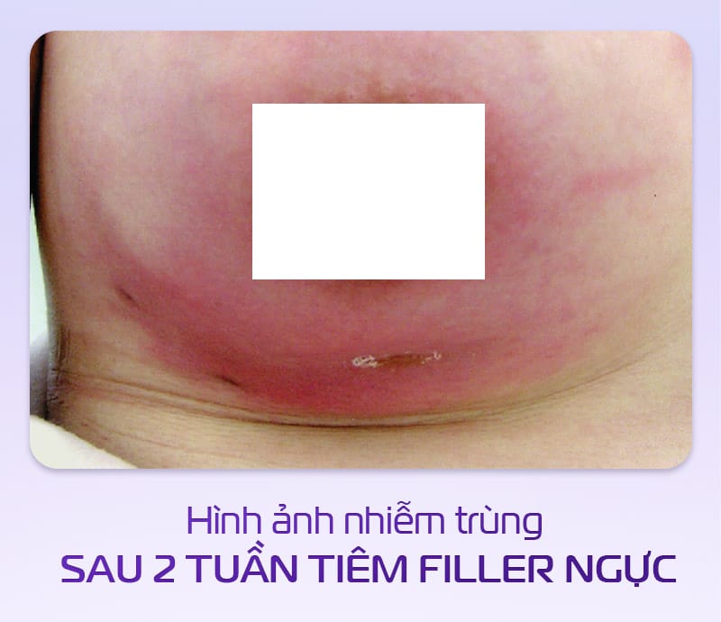 Tiêm HA có an toàn và có thể tan hoàn toàn nếu có vấn đề không?