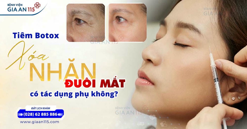 Bằng chứng lâm sàng: Botox an toàn về lâu dài không?