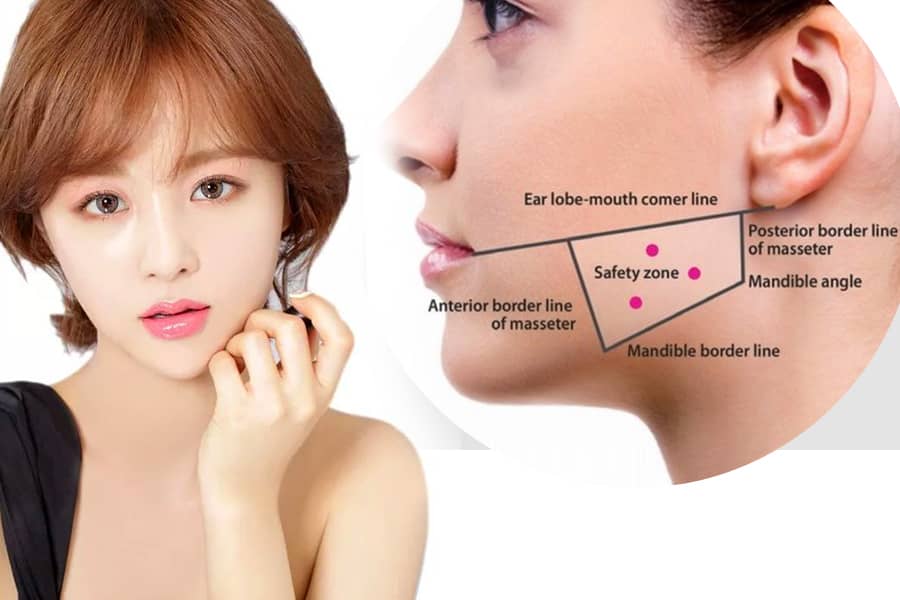 Những yếu tố nào quyết định “botox có tác dụng trong bao lâu” ở mỗi người?