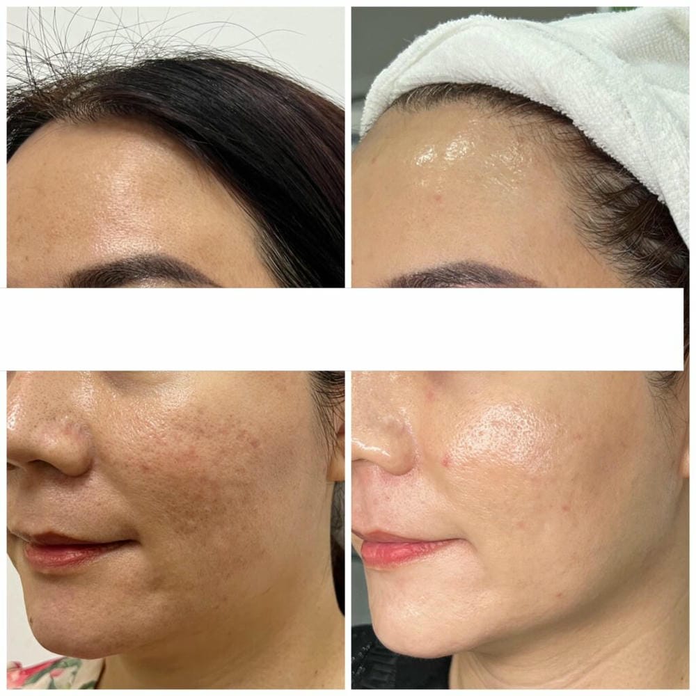 Chuẩn bị và quy trình tiêm