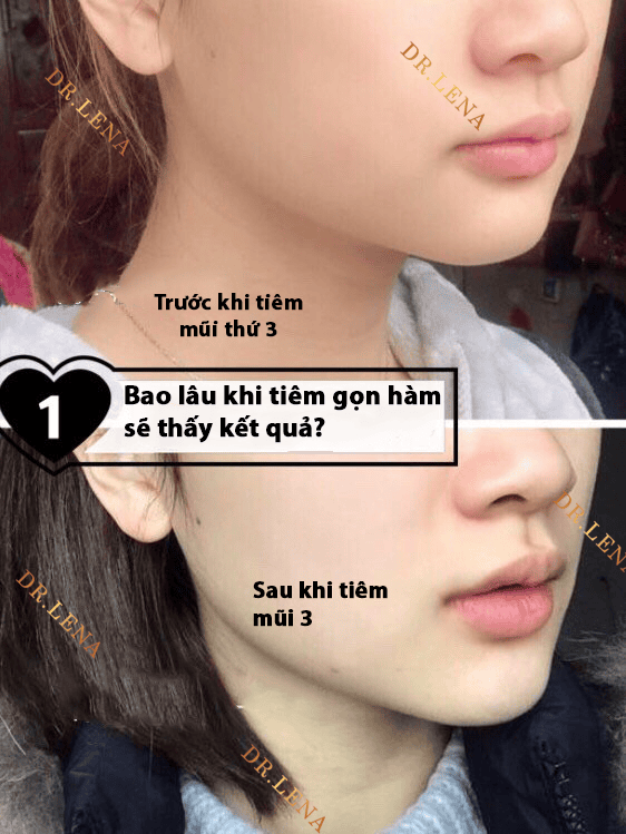 Bằng chứng y học: có cần lo về mất xương hàm khi tiêm lặp lại?