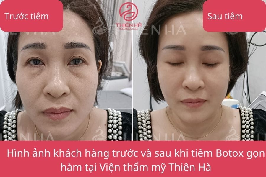 Làm sao để chọn nơi tiêm Botox gọn hàm đáng tin — checklist để giảm rủi ro và đạt kết quả tự nhiên?