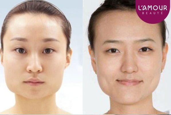 Botox mặt lệch có tự hết không — bao lâu thì hồi phục và có thể làm gì để đẩy nhanh?