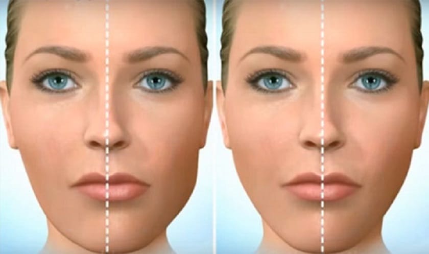 Quy trình an toàn khi muốn tiêm chỉnh bất đối xứng bằng Botox — bác sĩ cần làm gì và khách hàng cần lưu ý?