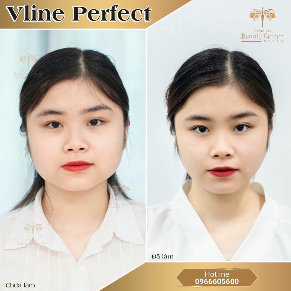 Ở đâu uy tín để xử lý Botox mặt lệch tại HCM, Hà Nội và Cần Thơ?