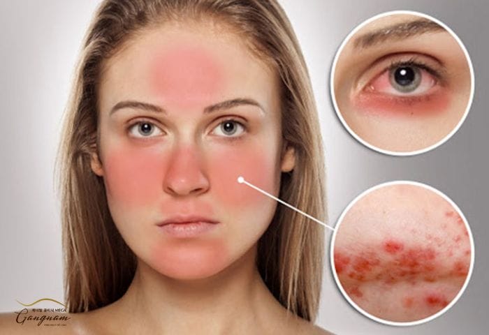 Làm sao để giảm rủi ro trước, trong và sau khi tiêm — an toàn tiêm botox?