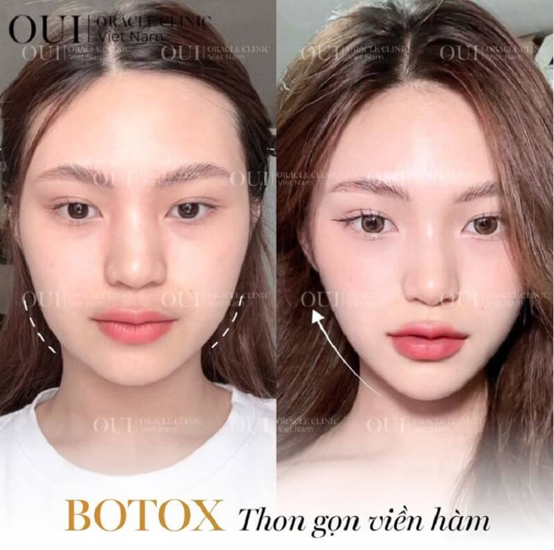 Những ai không phù hợp để tiêm botox hoặc filler?