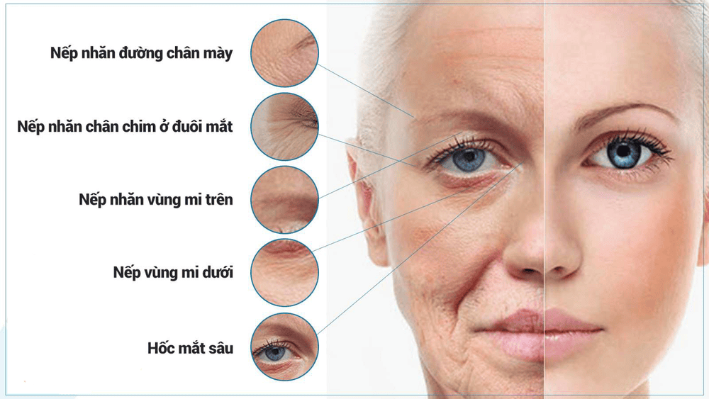 Lona Skin Lab có thể hỗ trợ như thế nào nếu quan tâm tiêm botox vùng mắt?
