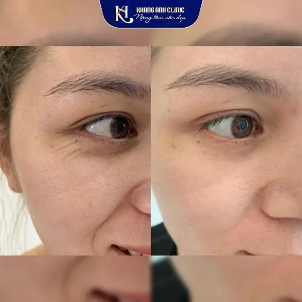 Làm sao để chọn nơi tiêm botox xóa nhăn mắt an toàn và cho kết quả tự nhiên?