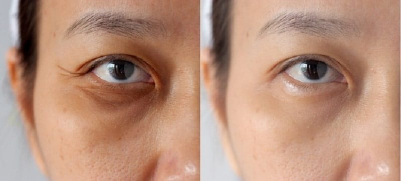 Bao lâu thì có thể tiêm lại?