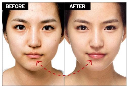 Bảng giá filler môi theo khu vực