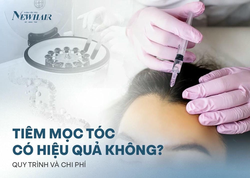 Làm sao so sánh hiệu quả giữa tiêm PRP, mesotherapy, exosome và cấy tóc FUE?