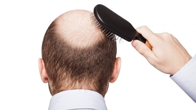 Tại sao chỉ bị hói giữa đầu — cơ chế phổ biến đằng sau hiện tượng này là gì?