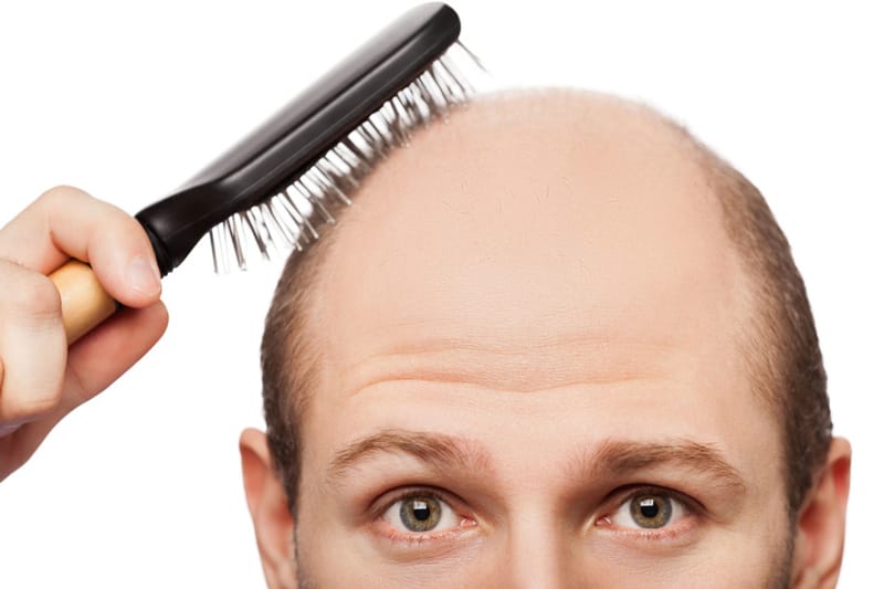Khi nào cần cân nhắc cấy tóc — và chuẩn bị gì?