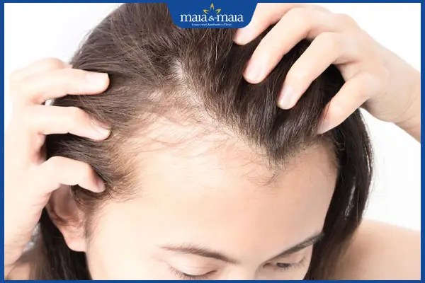 Làm sao phân biệt AGA, FFA hay traction — cần làm xét nghiệm gì?