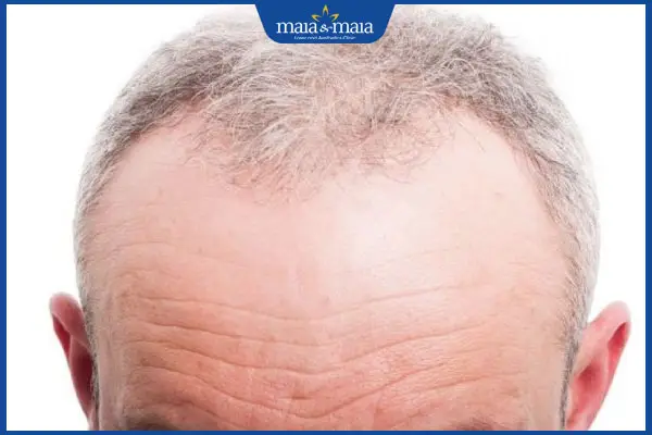 Điều trị phổ biến cho hói ở trán — phương pháp nào phù hợp?