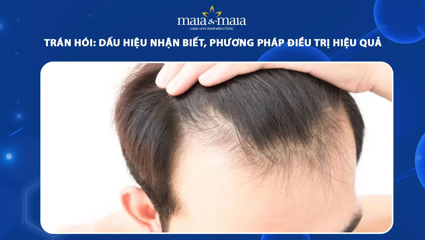 Liệu pháp PRP — có ích cho rụng tóc vùng trán?